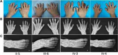 Case Report: Brachydactyly Type A1 Induced by a Novel Variant of in-Frame Insertion in the IHH Gene